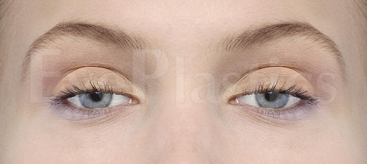 Photograph showing a patient with ptosis (drooping eyelid) before blepharoplasty (eyelid surgery).